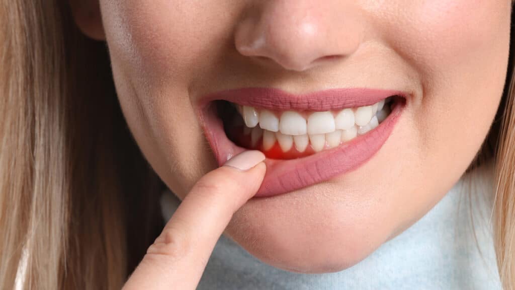 Periodontal Disease in Orlando, Florida
